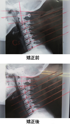 矯正前・矯正後