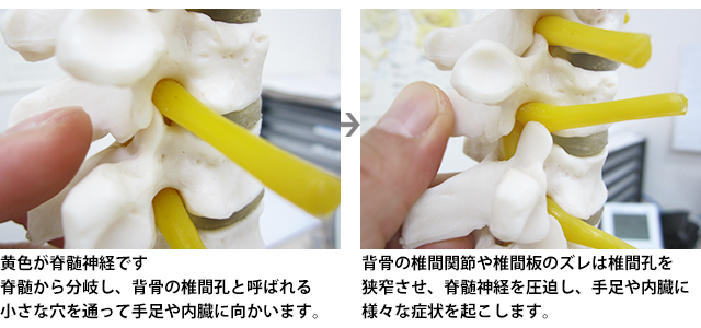 背骨の椎間関節や椎間板のズレは椎間孔を狭窄させ、脊髄神経を圧迫し、<br>
手足や内臓に様々な症状を起こします。