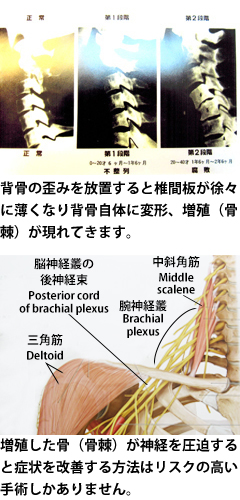 背骨の歪みを放置すると椎間板が徐々に薄くなり背骨自体に変形、増殖（骨棘）が現れてきます。増殖した骨（骨棘）が神経を圧迫すると症状を改善する方法はリスクの高い手術しかありません。